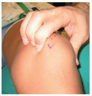 Illustration 7 for Chronic Patellar Instability: From Acute Onset to Lasting Solutions