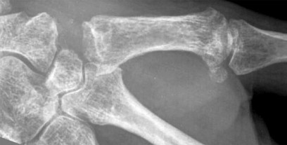 صورة طبية: دليل الأستاذ الدكتور محمد هطيف الشامل لأمراض وإصابات اليد والمعصم في صنعاء