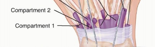 Illustration 8 for Effective K-Wire Fixation: Distal Radius Fractures Without External Fixation