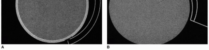 Illustration 2 for Beyond Knee Surg: Hip Arthroscopy for Sports Injuries