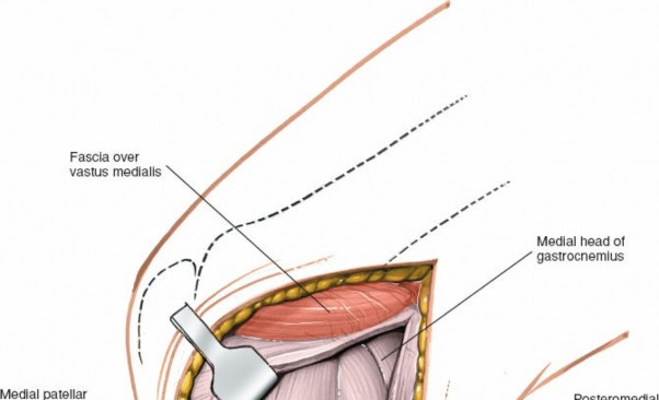 Illustration 70 for Mastering Knee Approaches: Spotlight on Superficial Medial Ligament