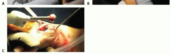 Illustration 46 for End Articular Cartilage Loss: Arthrosurface HemiCAP Resurfacing