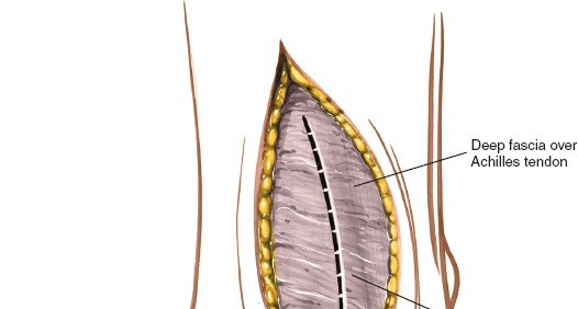 Illustration 19 for Step-by-Step Medial Side of the Ankle Approach Guide
