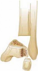 Illustration 42 for Pediatric Ankle Fractures: Management to Prevent Long-Term Issues