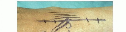 Illustration 10 for Precision Correction for Distal Radius Malunion