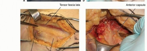 Illustration 15 for Is a Sliding Hip Screw Best for Your Femoral Neck Fracture?