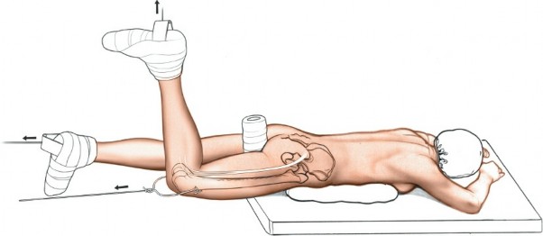 Illustration 3 for Acetabulum Posterior Approach: Simplest Fix for Hip Fractures