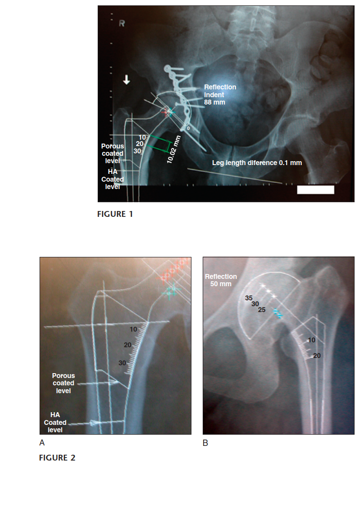 Illustration 3 for Templating for Primary THA: Optimize Outcomes & Avoid Pitfalls
