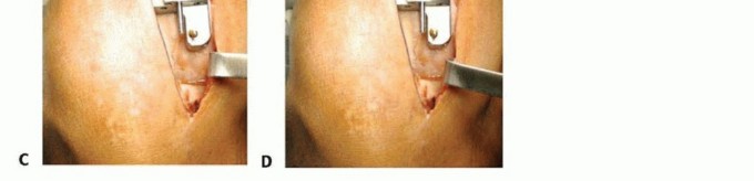 صورة طبية: استبدال مفصل الركبة الجزئي: حل متقدم لآلام الركبة المستمرة مع الأستاذ الدكتور محمد هطيف