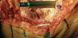 صورة توضيحية لـ ترقيع العظم بالضغط في جراحة مراجعة مفصل الركبة الصناعي: حلول متقدمة لنقص العظم مع الأستاذ الدكتور محمد هطيف في صنعاء