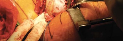 Illustration 22 for Metal on Metal Resurfacing: Enhanced Posterior Soft Tissue Repair