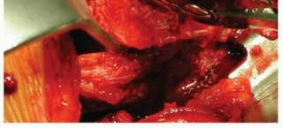 Illustration 11 for Why Polished Tapered Cemented Stems Excel in Hip Replacement