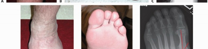 Illustration 7 for Regain Mobility: Surgical Solutions for Charcot Foot Arthropathy