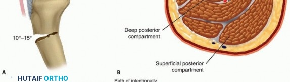 Illustration 2 for Optimizing Intramedullary Nailing for Tibial Shaft Fractures