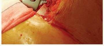 Illustration 17 for Why Polished Tapered Cemented Stems Excel in Hip Replacement