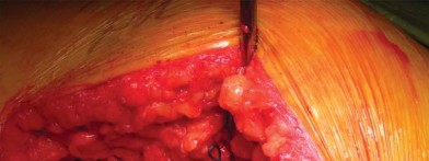 Illustration 59 for Unlock better THA: The technique of short stem for less invasiveness