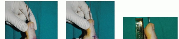 Illustration 21 for MTP Joint Arthrodesis: The Key to Optimal Toe Positioning