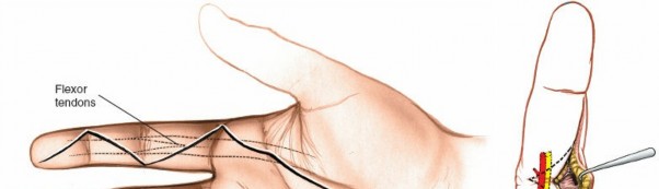 Illustration 143 for Essential Surgical Approaches: Uncover Every Aspect of the Wrist