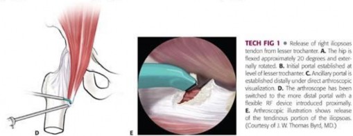 Illustration 102 for Stop the Snap: Hip Preservation for Snapping Iliopsoas Tendon