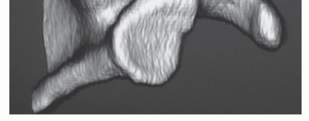 Illustration 4 for Find Relief: Arthroscopic Subacromial Decompression for Impingement