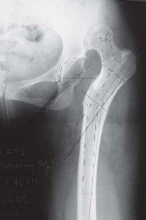 Illustration 26 for Successful Total Hip Replacement in Developmental Dysplasia