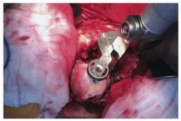 Illustration 6 for Recreate Hip Biomechanics: Modular Stems for Modular Solutions