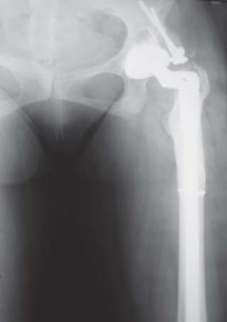Illustration 35 for Successful Total Hip Replacement in Developmental Dysplasia
