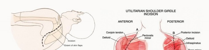 Illustration 7 for Mastering Total Scapular Resections: Reconstruction & Outcomes
