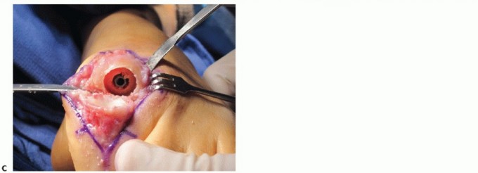 Illustration 32 for End Articular Cartilage Loss: Arthrosurface HemiCAP Resurfacing