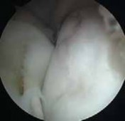 Illustration 33 for Precision Arthroscopy for Chondral Injuries & OCD: Direct Lateral Portal