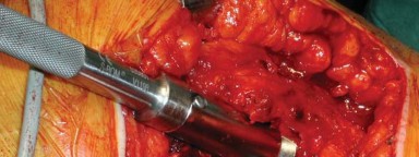 Illustration 22 for S-ROM: Inside the Technique of Modular Implant Design