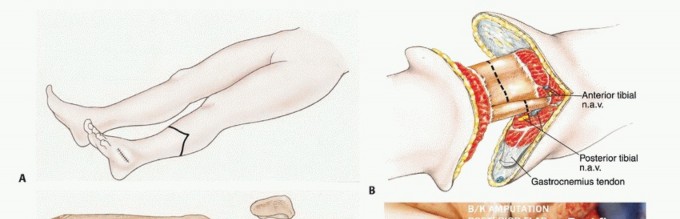 Illustration 8 for Below-Knee Amputation: Maximize Your Below-Knee Recovery & Function