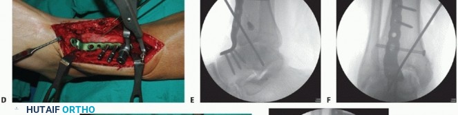 Illustration 29 for Optimize Pain Management with Proximal Ring Block for Ankle Arthrodesis