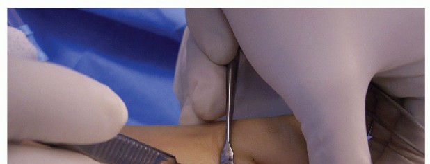 Illustration 22 for Hammer Toe Correction: Understanding the Extensor Digitorum Longus