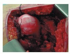 Illustration 3 for Hip Resurfacing: The Bone-Sparing Solution around the Femoral Head