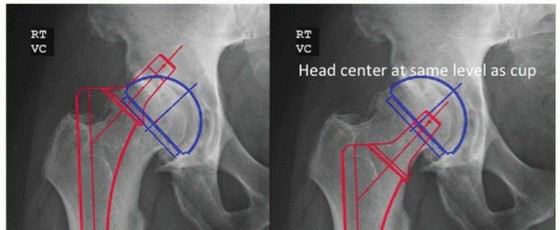 Illustration of extensively porouscoated stems - Dr. Mohammed Hutaif