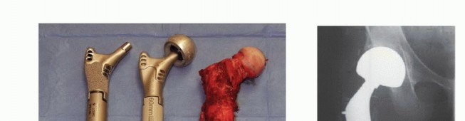 Illustration 14 for Distal Femoral Replacement: Key to Modern Limb Salvage