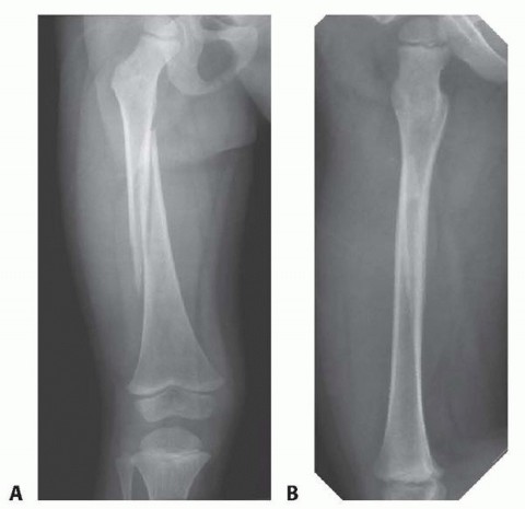 Best Practices for Pediatric Femur Reduction and Spica Casting