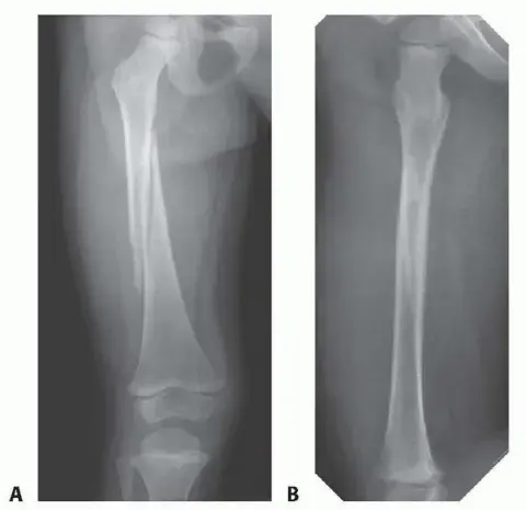 صورة توضيحية لـ كسور عظم الفخذ لدى الأطفال: دليل شامل للعلاج بالجبيرة والتعافي مع الأستاذ الدكتور محمد هطيف
