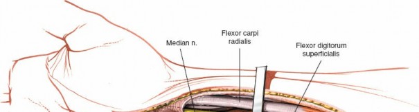 Illustration 29 for Volar Approach: Optimal Exposure for the Volar aspect of the Distal Radius