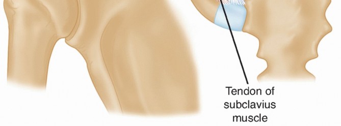 Illustration 6 for Optimizing SC Dislocation Repair After Medial Clavicle Resection