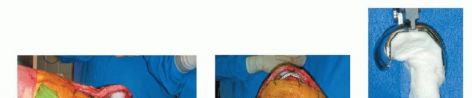 Illustration 23 for Correcting Stiffness in Revision TKA: Achieve Appropriate External Rotation