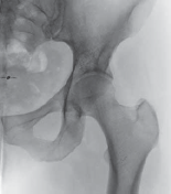 Illustration 32 for FAI: Impingement and Surgical Dislocation Explained
