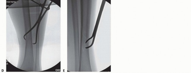 Illustration 28 for Optimizing Intramedullary Nailing for Tibial Shaft Fractures