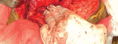 صورة طبية: إتقان توازن الأنسجة الرخوة لمفصل ورك صناعي مثالي: دليل شامل للمرضى مع الأستاذ الدكتور محمد هطيف