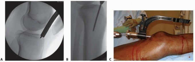 Illustration 43 for Advanced Nailing of the Mature Tibia: Overcoming Complexities