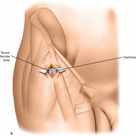 Illustration 23 for Expert Guide: Ulna and Wrist External Fixation Pin Placement