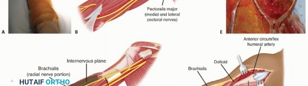 Illustration 10 for Surgical Approaches to Shoulder & Elbow: Pearls and Pitfalls