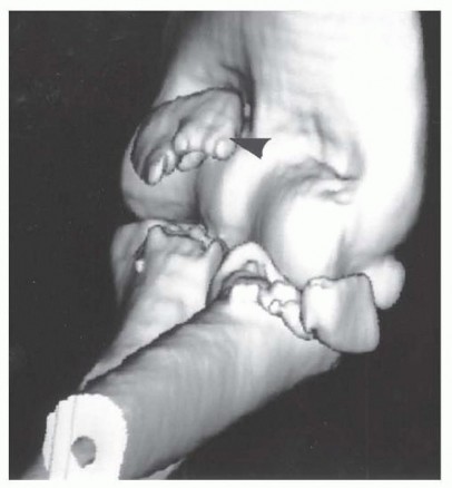 Illustration 10 for Restore Stability & Motion: Fixation of Fracture-Dislocations