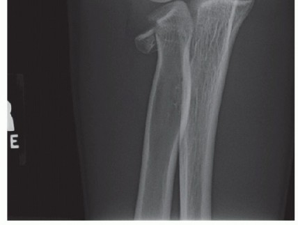 Illustration 8 for Radial Head & Neck Fractures: Mastering ORIF for Best Results